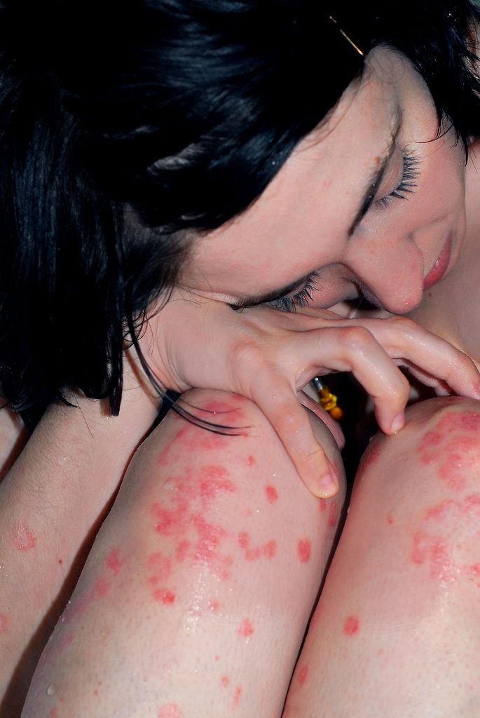 woman sat hugging her knees and legs which are covered in psoriasis
